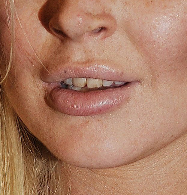 Lindsay chwali się nowymi zębami!